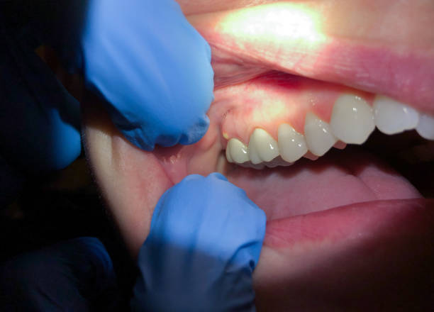 Best Urgent Care for Lost Fillings or Crowns in Lake Royale, NC